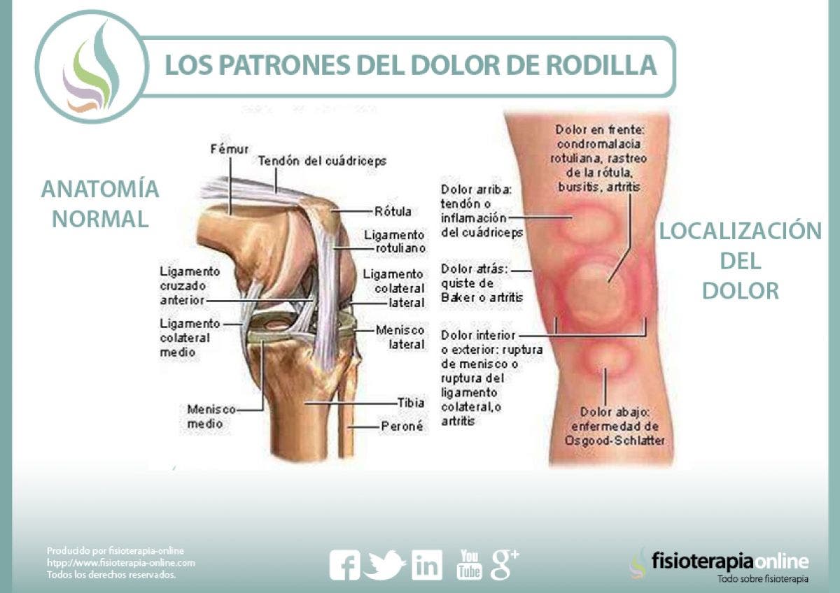 Los Patrones Del Dolor De Rodilla O Gonalgia Y Las Lesiones Más Comunes Fisioonline