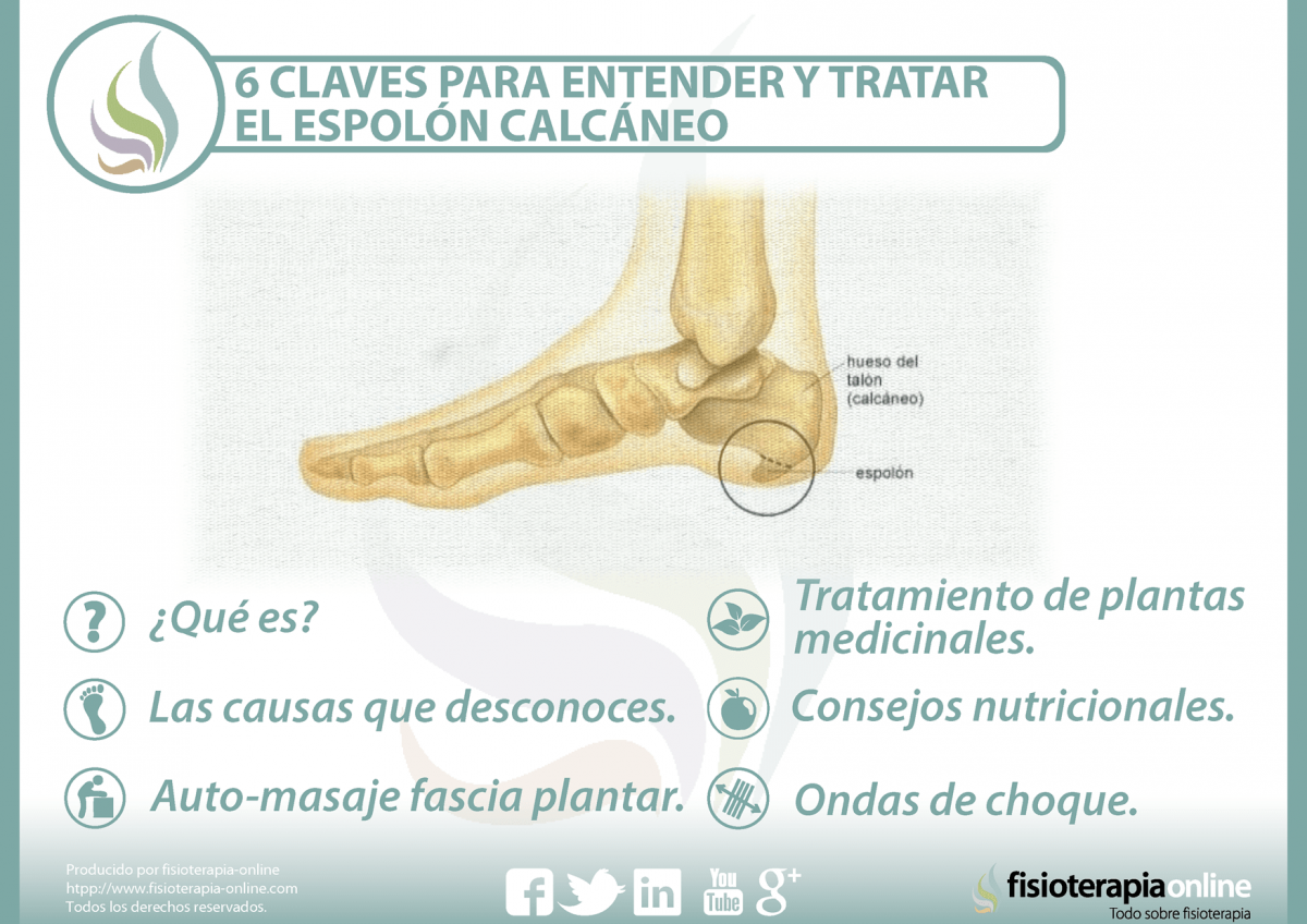 6 claves para entender y tratar el espolón calcáneo