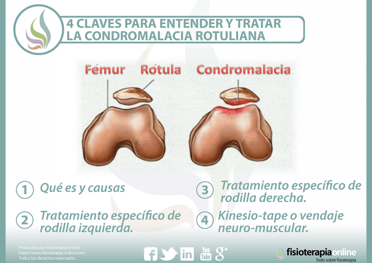 4 claves para entender y tratar la condromalacia rotuliana