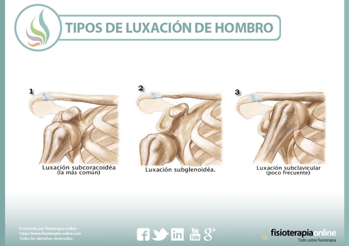 Luxación de hombro. Qué es y cuales son sus tipos