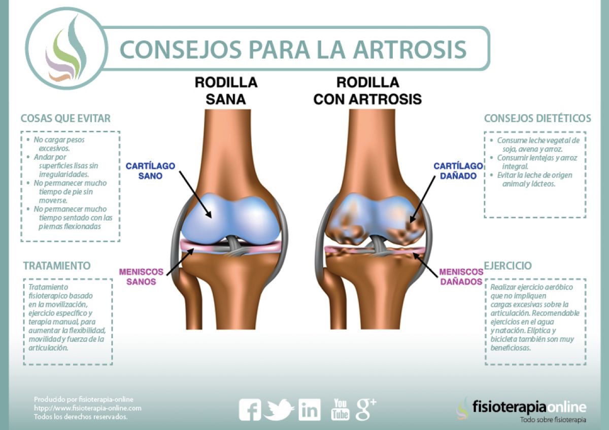 Consejos para tratar la artrosis