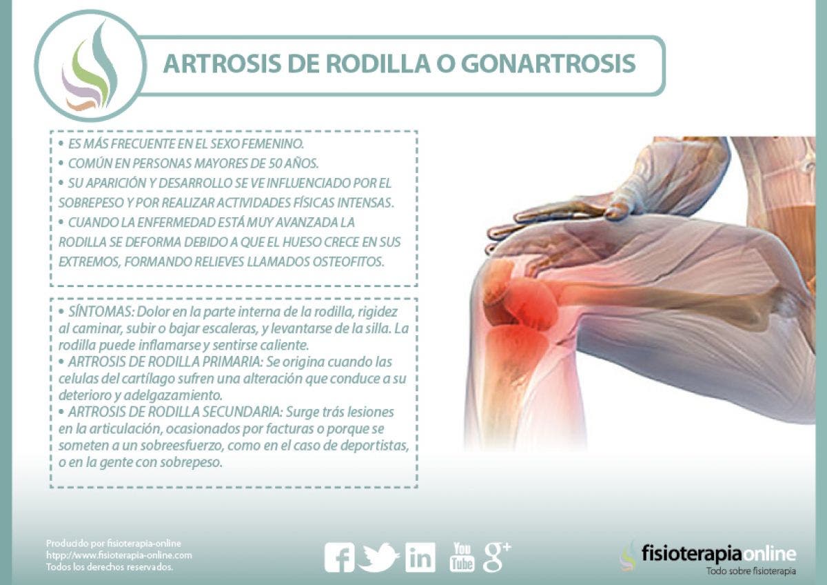 Todo lo que necesitas saber de la artrosis de rodilla o gonartrosis