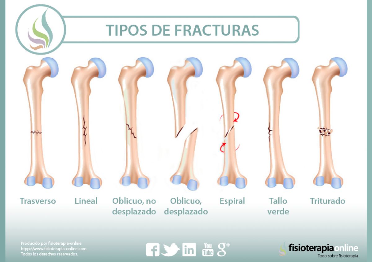 Fracturas óseas, tipos, cuidados y tratamiento