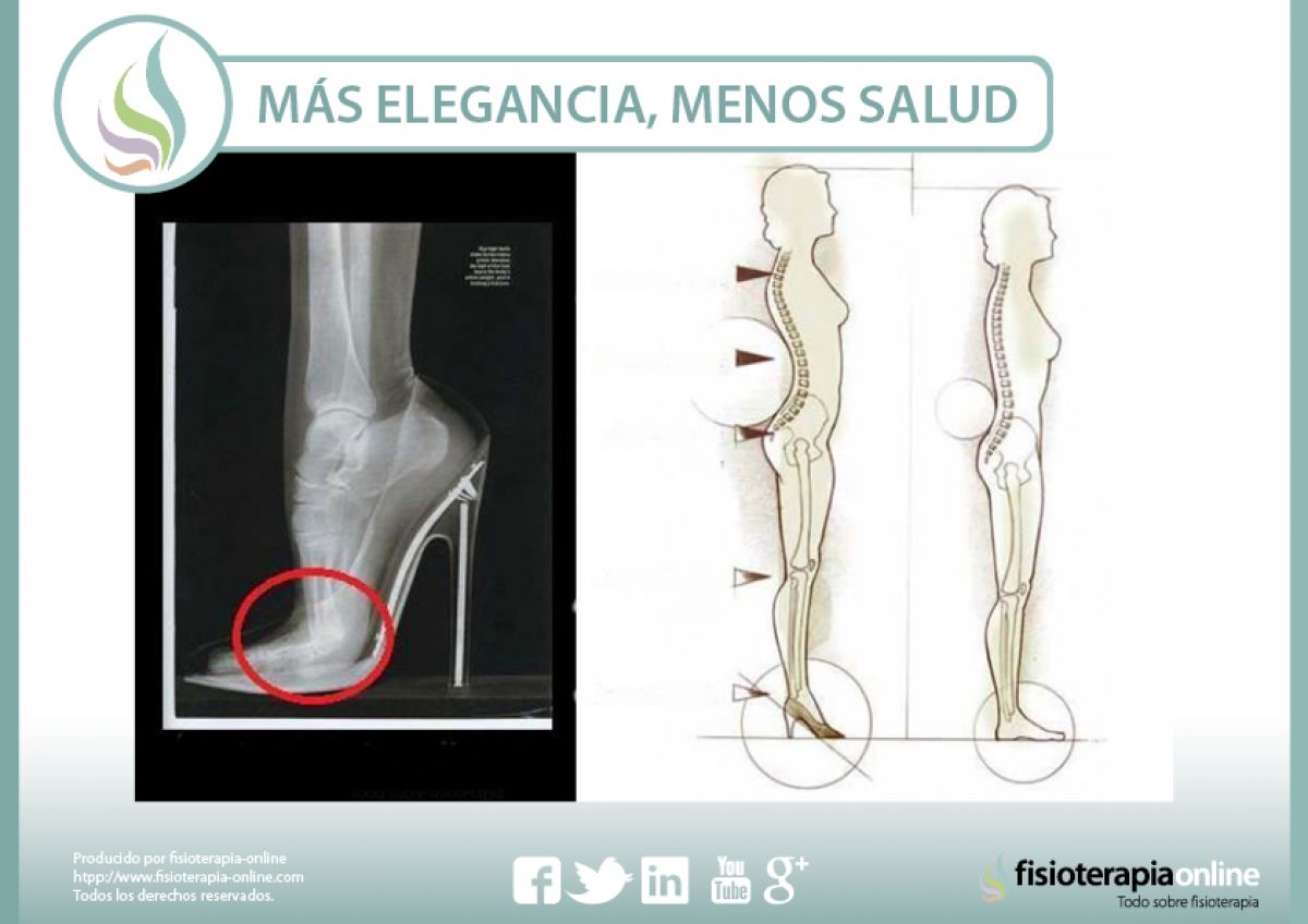 Más elegancia, menos salud. Cuidado con el abuso de los tacones, pueden facilitar problemas de espalda y alterar la correcta postura corporal