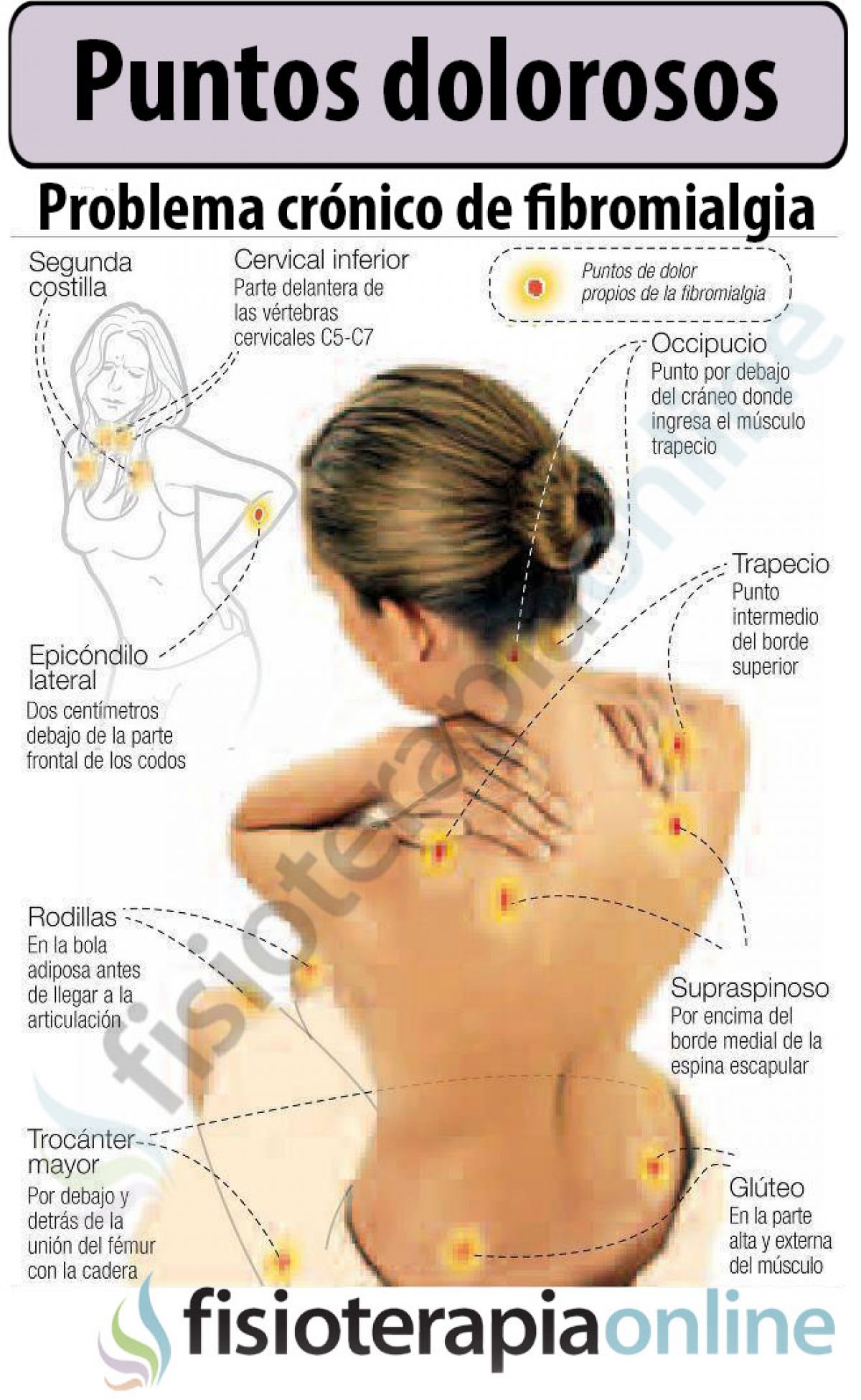 La fibromialgia, un trastorno que enfoca tu cerebro hacia el dolor