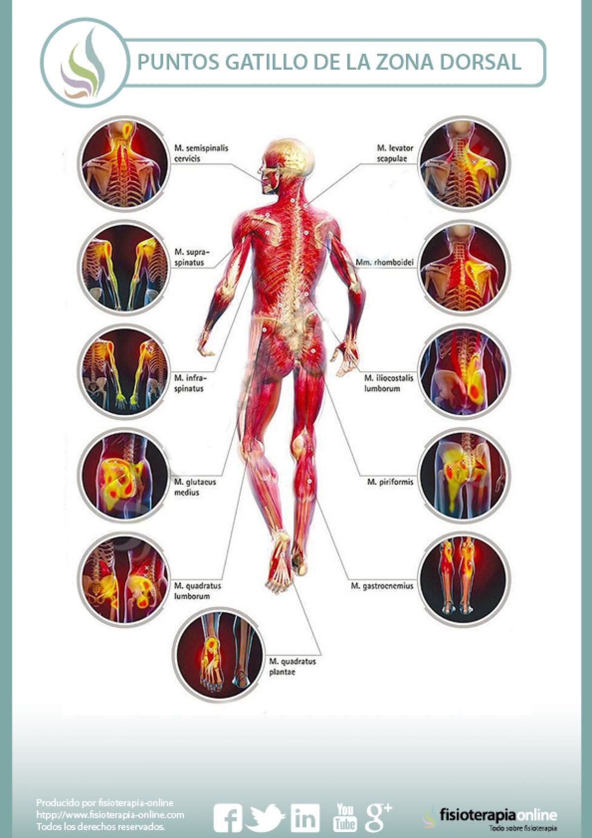 Puntos gatillo de la zona dorsal, los causantes musculares de la dorsalgia