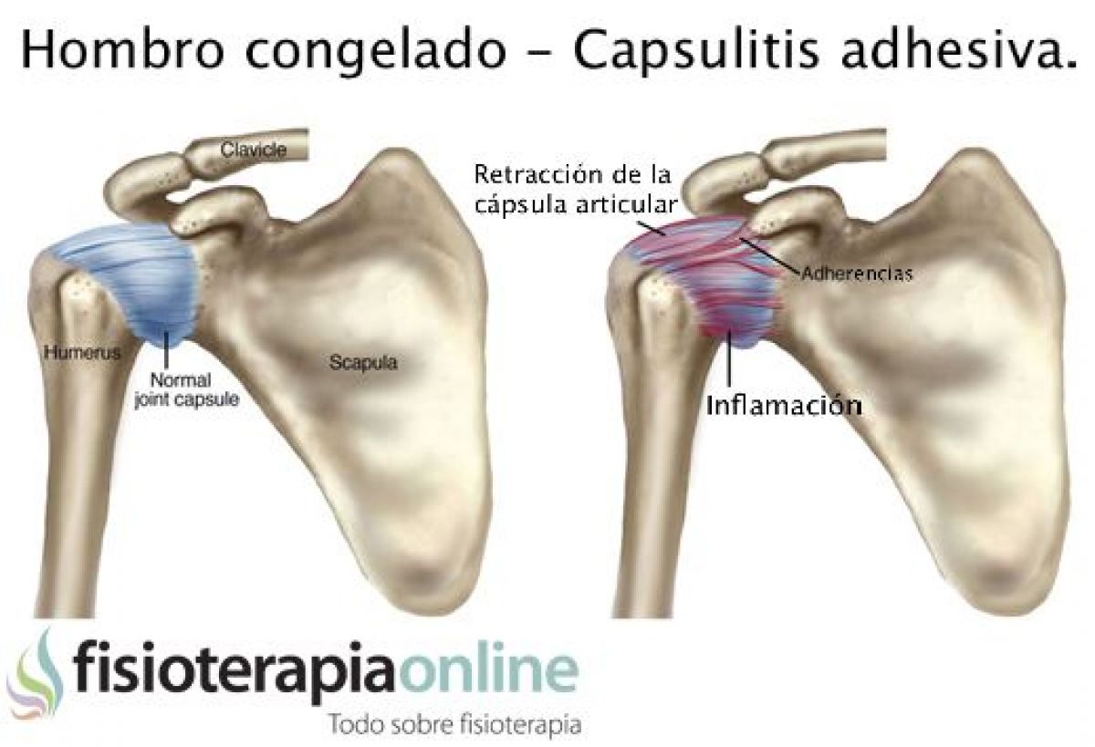 Hombro congelado o capsulitis adhesiva, unos útiles consejos e información para que sepas cómo afrontarlo