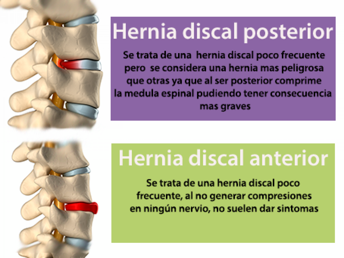 Las hernias discales pueden ser muy diferentes, aprende cómo son algunas de ellas