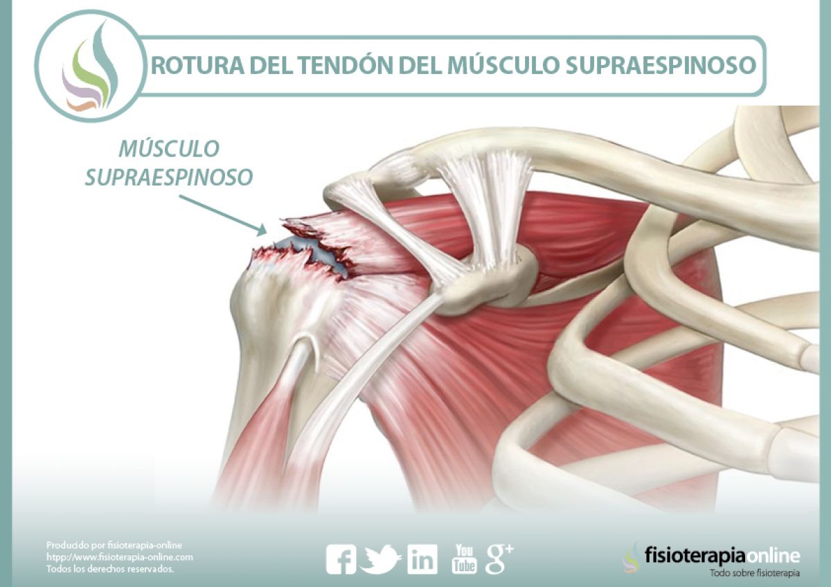 Rotura del  tendón del músculo supraespinoso, información y consejos para su prevención