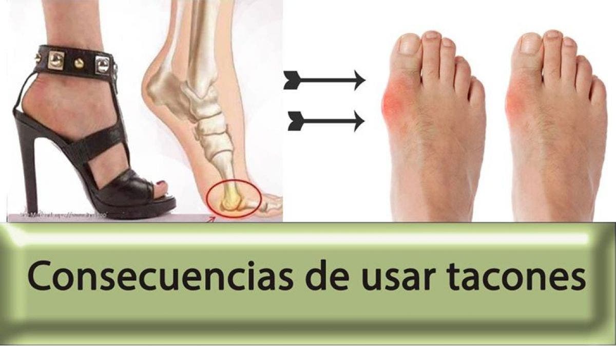 El juanete o hallux valgus, el castigo de la mujer con tacones