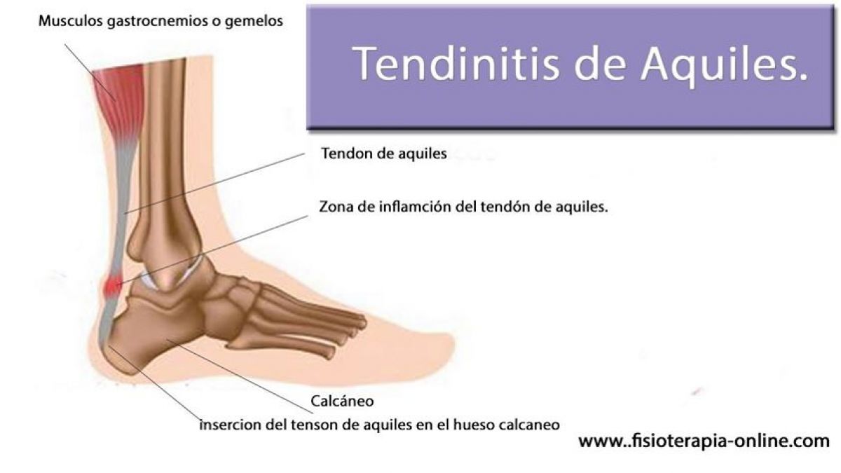 Tendinitis o tendinosis del tendón de Aquiles. Información, consejos y un útil automasaje