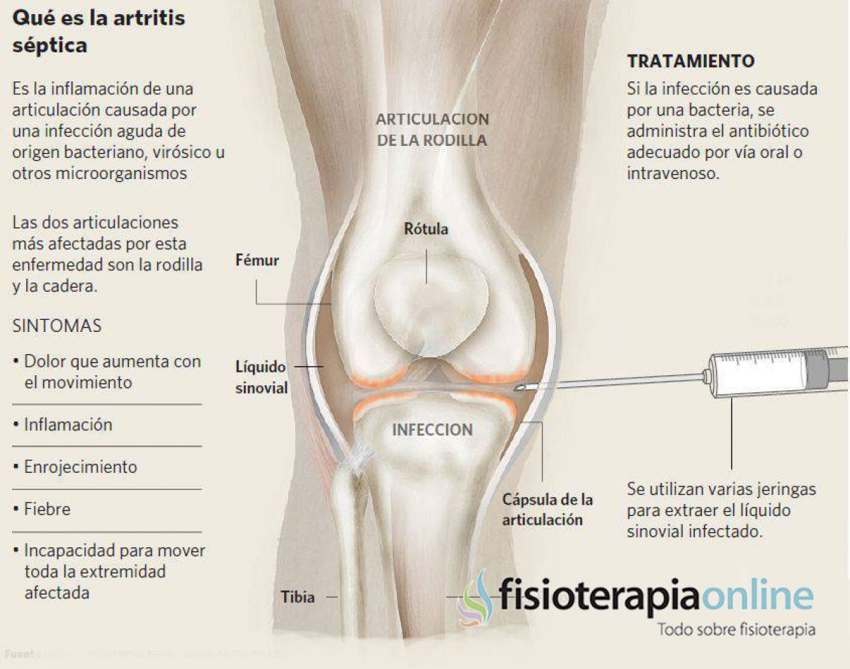 La artritis o inflamación articular, información, consejos y un clarificador vídeo sobre su origen, causas y tratamiento