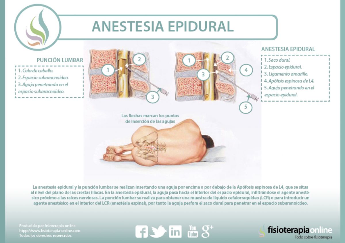 Anestesia Epidural Descubre Sus Indicaciones Y Sus Peligros Fisioonline