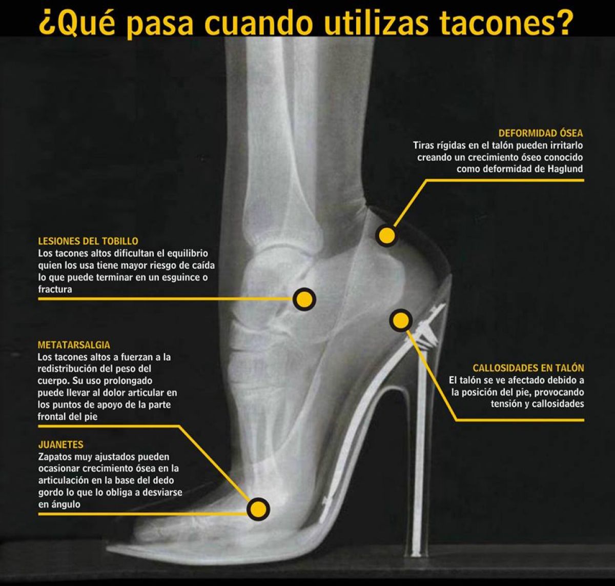 Juanetes, lesiones de tobillo, metatarsalgia, callosidades en el talón, deformidad ósea, consecuencia de los tacones