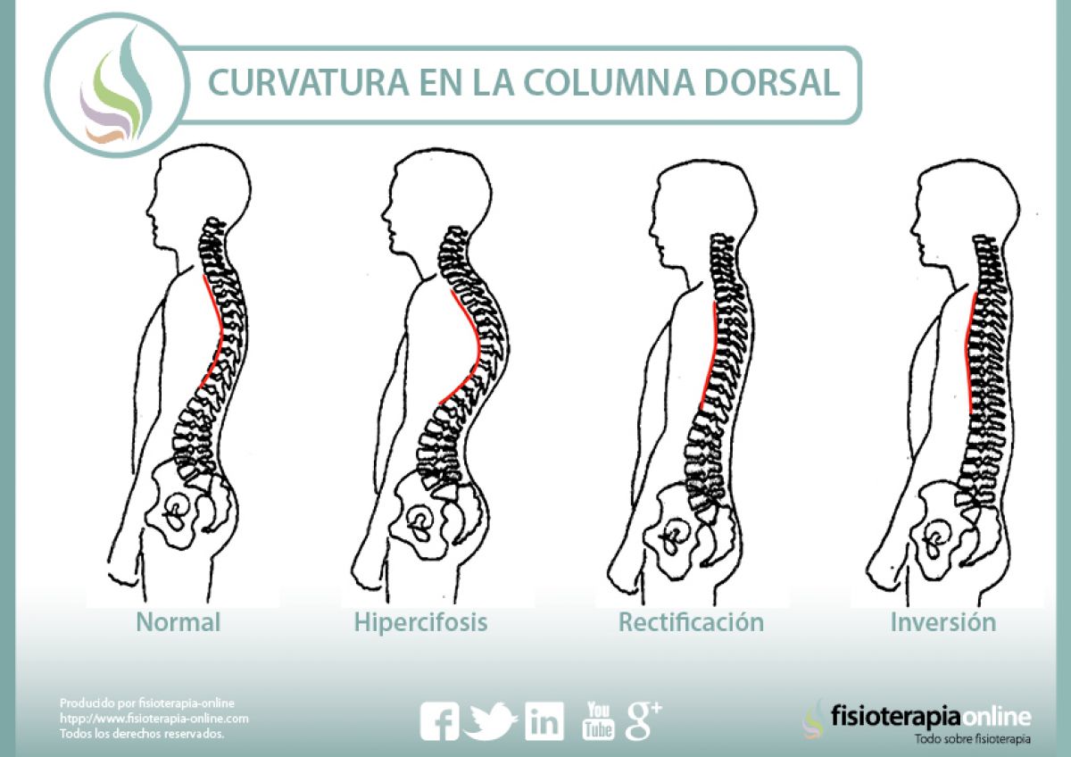 Hipercifosis, aprende que es y como corregirla