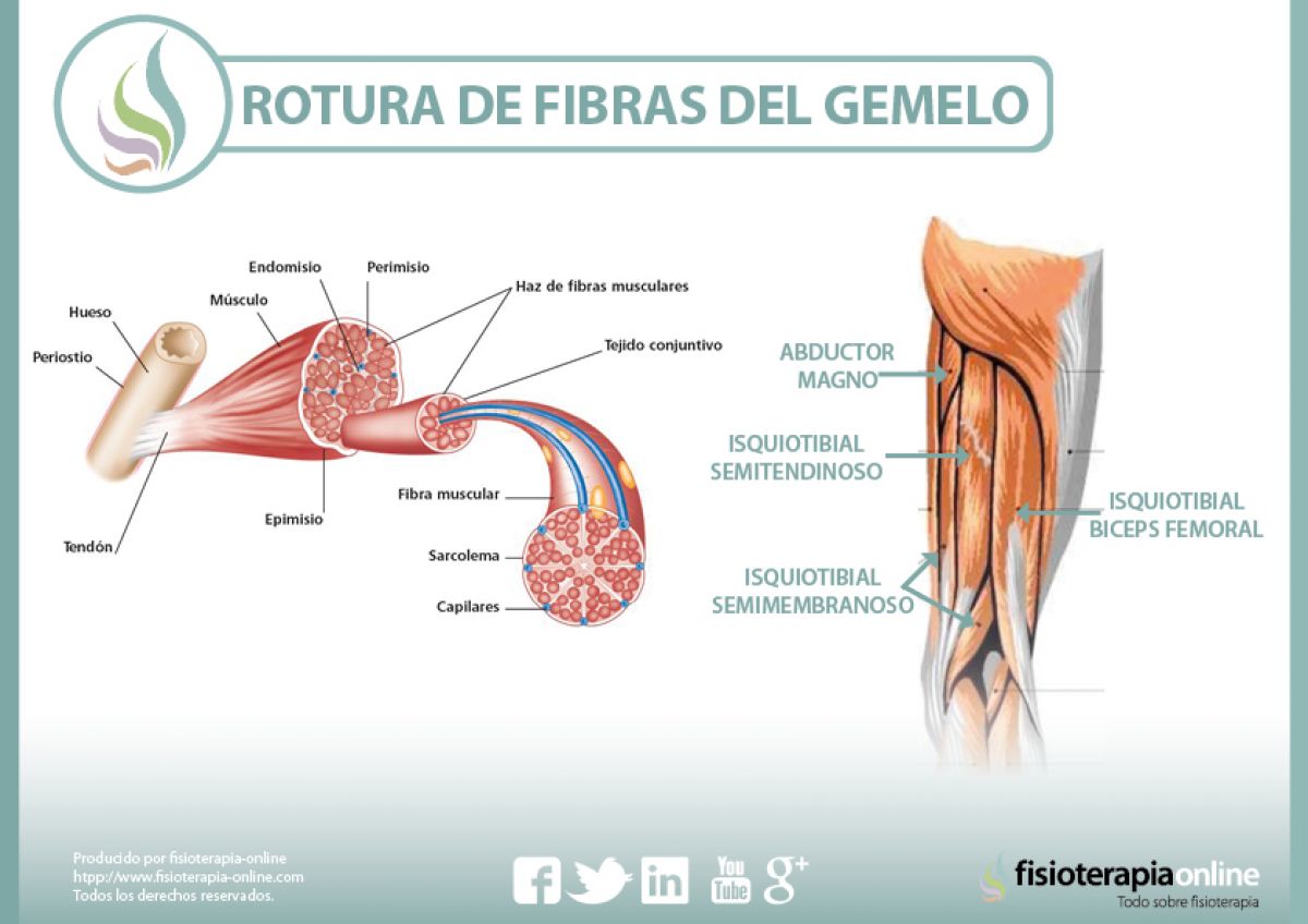 Rotura de fibras del gemelo o gastrocnemio, una lesión frecuente