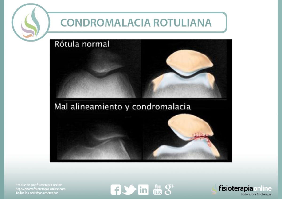 Condromalacia o condropatía rotuliana, causas, y tratamiento de una alteración mecánica