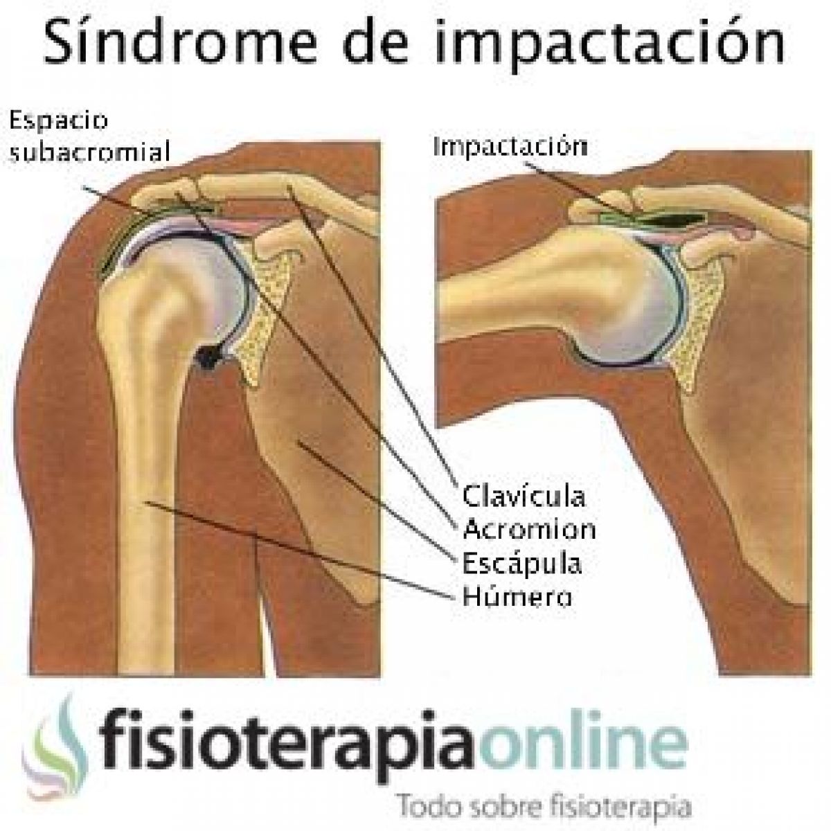 Síndrome de impactación. ¿Sabes qué es y cuales son sus causas?