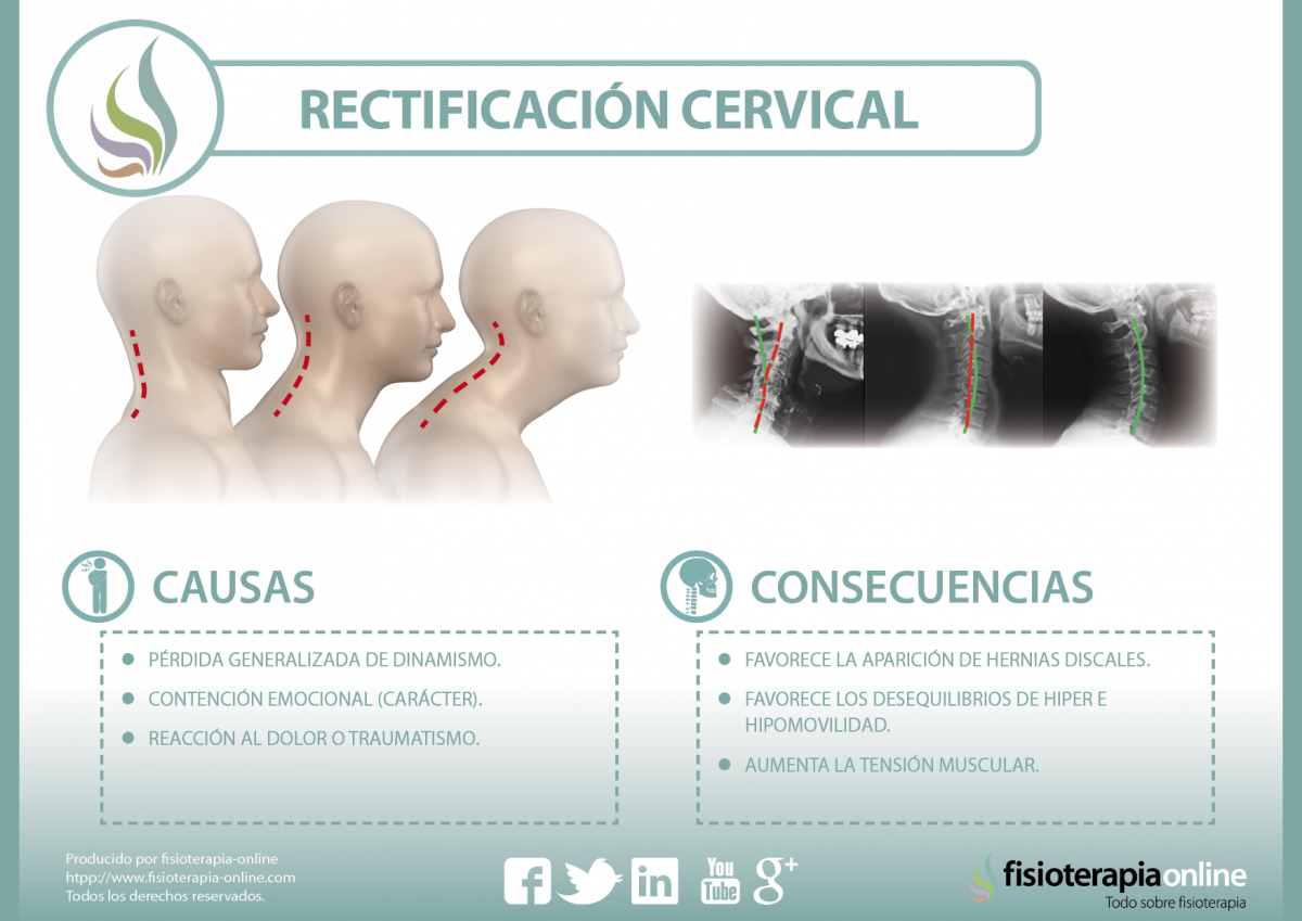 La rectificación cervical, una disfunción en auge, descubre qué es y a que se debe