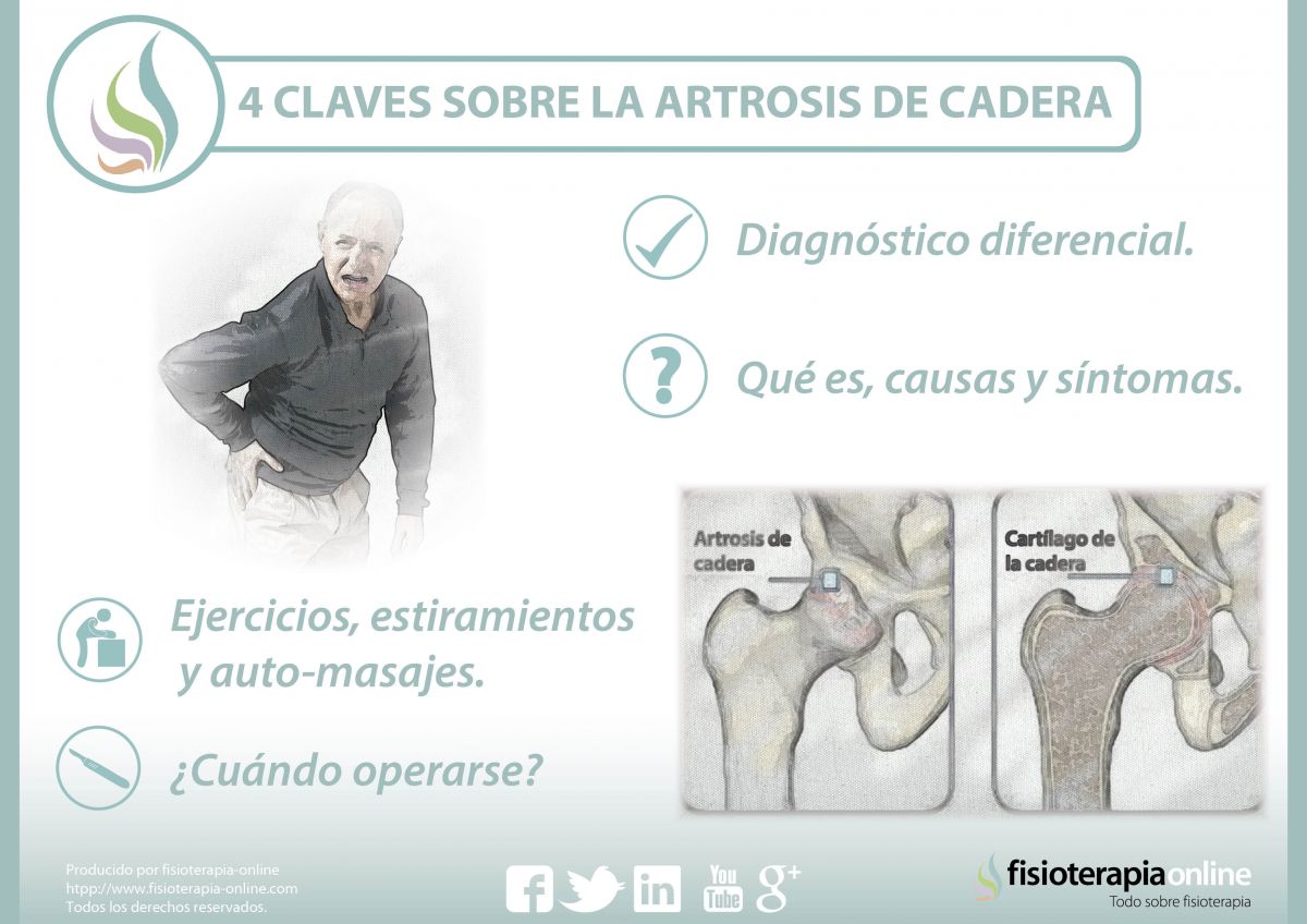 4 claves sobre la artrosis de cadera