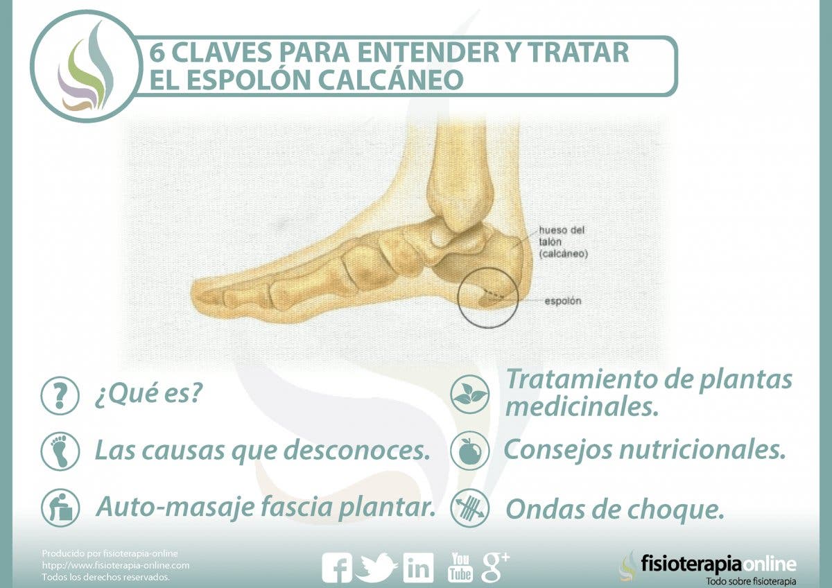 6 claves para entender y tratar el espolón calcáneo