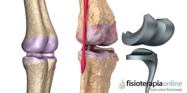 Rehabilitación de una prótesis de rodilla o artroplastia de rodilla. Consejos, ejercicios y fases de tratamiento