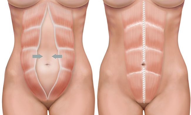 Diástasis de los rectos abdominales. Qué es y consejos para su cuidado.