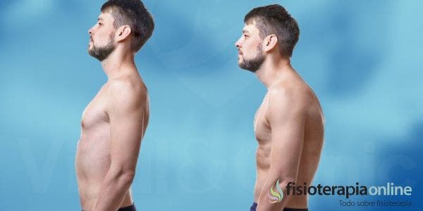 ¿Cómo puedo corregir la cabeza adelantada con técnicas de fisioterapia?