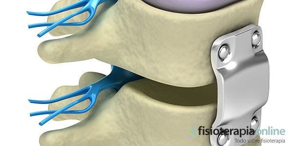 Artrodesis. Qué es, indicaciones, riesgos y ejercicios de fisioterapia