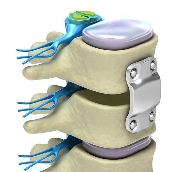 Artrodesis lumbar: Qué es, indicaciones, riesgos y tratamiento de fisioterapia.