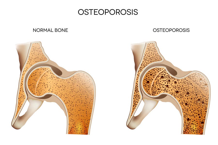 Osteoporosis: Causas, síntomas y tratamiento dietético y nutricional.