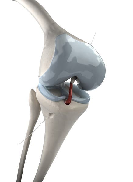 Lesión del ligamento cruzado anterior. Causas, ejercicios y tratamiento de fisioterapia.