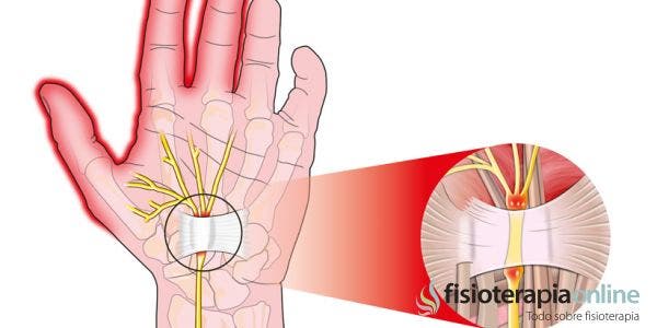 Sindrome del túnel carpiano. Ejercicios y tratamiento recomendado