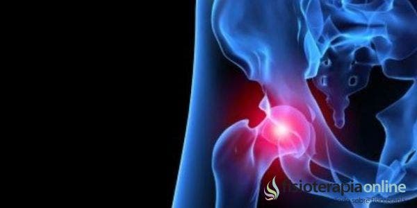 ¿Cuáles son las claves que permiten el diagnóstico del pinzamiento femoroacetabular?