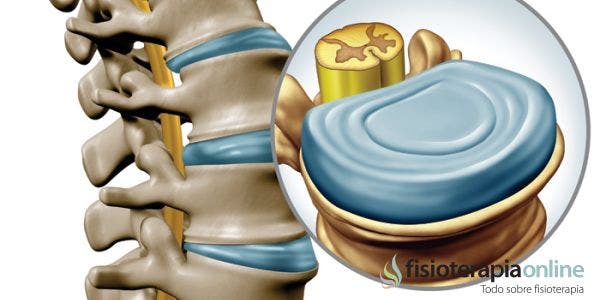 5 Curiosidades que no sabías sobre el disco intervertebral, su estructura y su funcionamiento