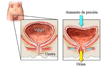 presión y vejiga en incontinencia