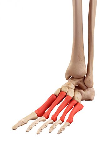Metatarsalgia, síntomas, causas, complicaciones y tratamiento