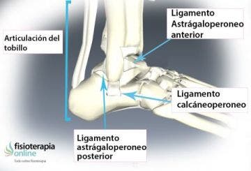 esquema de un esguince de tobillo