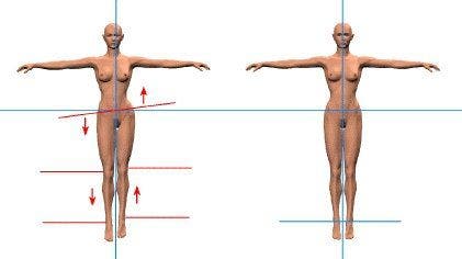 Dismetría de las piernas o extremidades inferiores