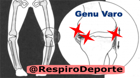 Varo de rodilla