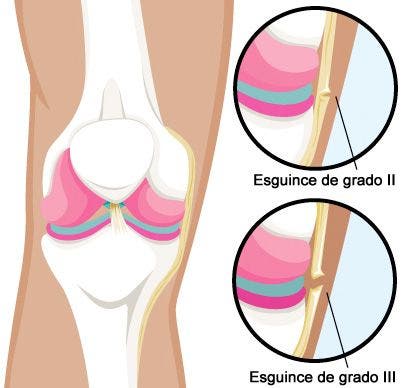 Rotura o esguince de ligamento lateral interno de la rodilla. ¿Qué es? causas, tratamiento fisioterapéutico.