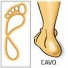 Pie cavo, excavado o hueco: qué es y tratamiento en fisioterapia