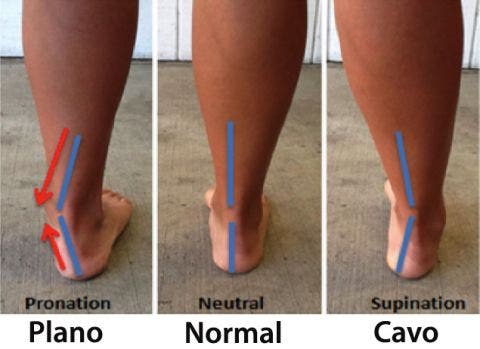 Pie cavo, excavado o hueco: qué es y tratamiento en fisioterapia