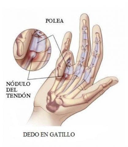 Todos los años Los invitados Cubo Dedo en gatillo o en resorte. Qué es, causas, síntomas y tratamiento Todos los años Los invitados Cubo Dedo en gatillo o en resorte. Qué es, causas, síntomas y tratamiento