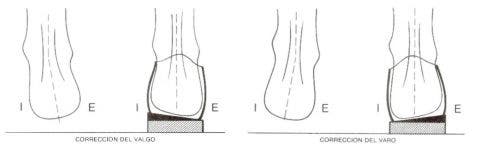Pie cavo, excavado o hueco: qué es y tratamiento en fisioterapia