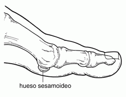 Pie cavo, excavado o hueco: qué es y tratamiento en fisioterapia