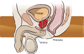 Los hombres y la fisioterapia uroginecológica: próstata, incontinencia y suelo pélvico