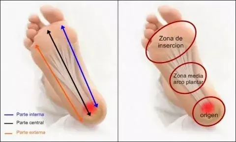 ¿Qué es la fascitis plantar? Causas, diagnóstico y tratamiento