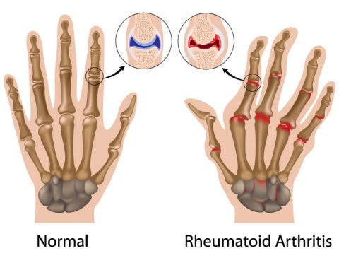 Fisioterapia en reumatología o reumatológica