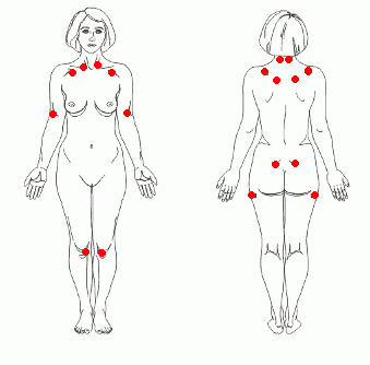 Puntos reflejos en la fibromialgia